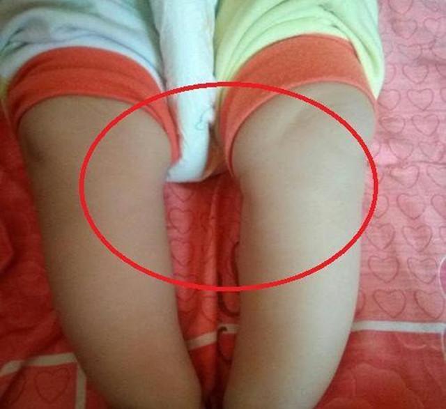 腿弯怎么办，会是“罗圈腿”吗（10岁孩子腿弯怎么办）