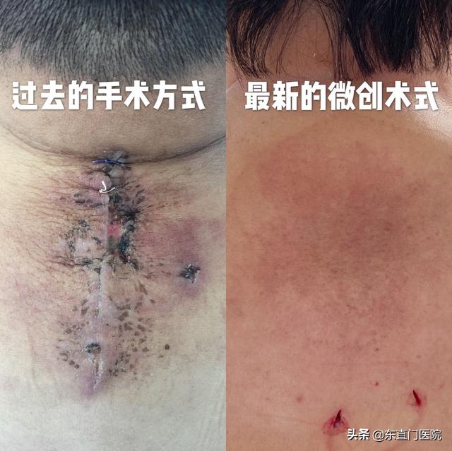 富贵包会自己消除吗 富贵包微创手术几天可以出院，富贵包会自己消除吗（东直门医院骨科外科联合研发微创可视化旋切技术治疗颈部富贵包）