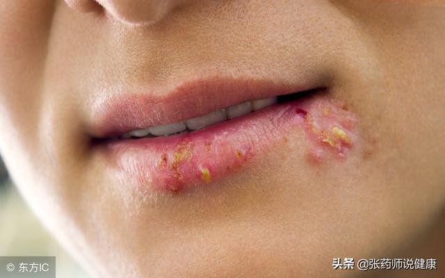 嘴唇发炎怎么办,嘴唇干裂发炎怎么办(平常对嘴唇的护理是关键)