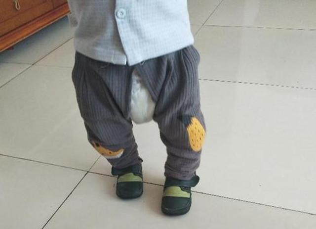 腿弯怎么办，会是“罗圈腿”吗（10岁孩子腿弯怎么办）