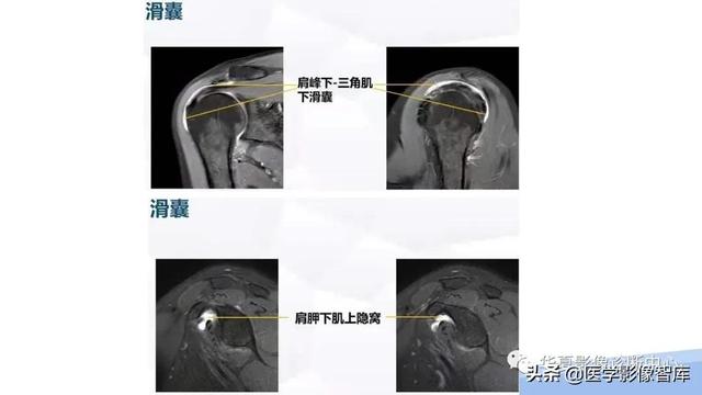 肩关节骨标志解剖图，全面掌握肩关节解剖