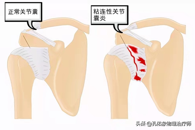 肩周炎用什么护肩好，护肩周炎用哪个好（一文告知您全面了解冻结肩的治疗）