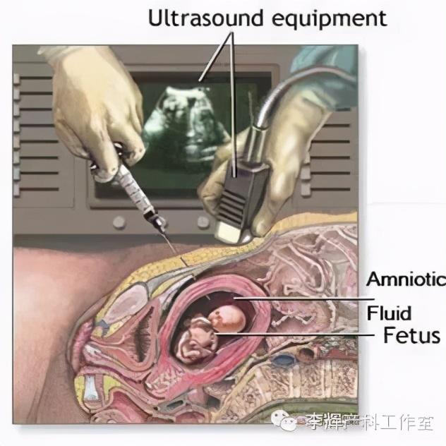 绒毛穿刺是什么，绒毛穿刺是什么会不会对胎儿造成影响（侵入性产前诊断技术有哪些）