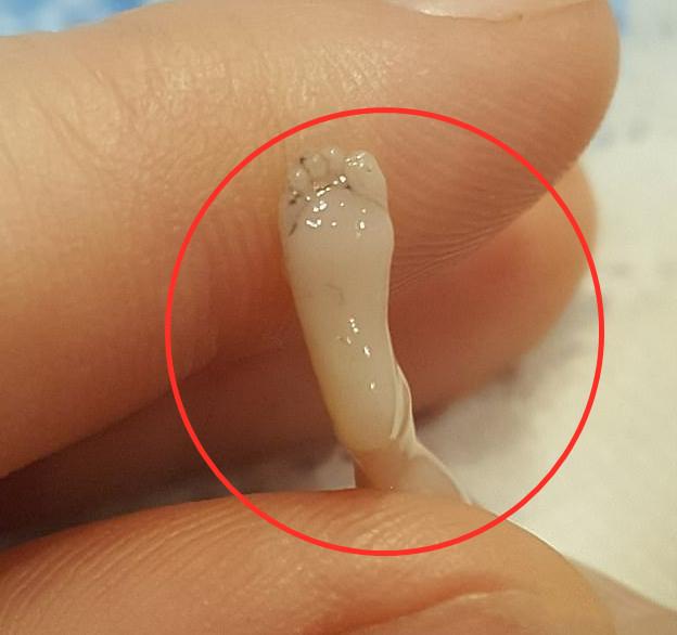 三个月胎儿真实图片(宝妈怀孕14周后流产) - 乐宝宝贝