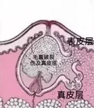 什么能祛痘和痘印，用什么可以祛痘祛痘印（红痘印黑痘印一年也去不掉）