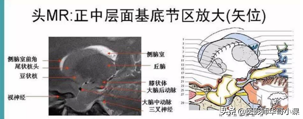 颅脑mri(头部MRI)插图(64)