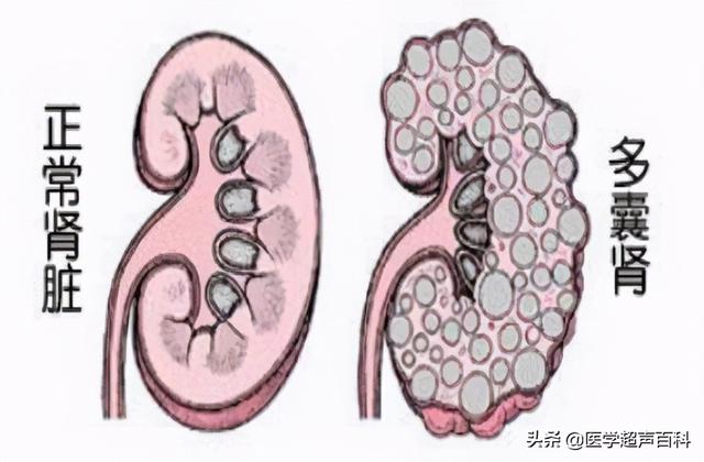 多囊肾遗传孩子多大能查出来，多囊肾会遗传几代人（对肾的损害性有多大）