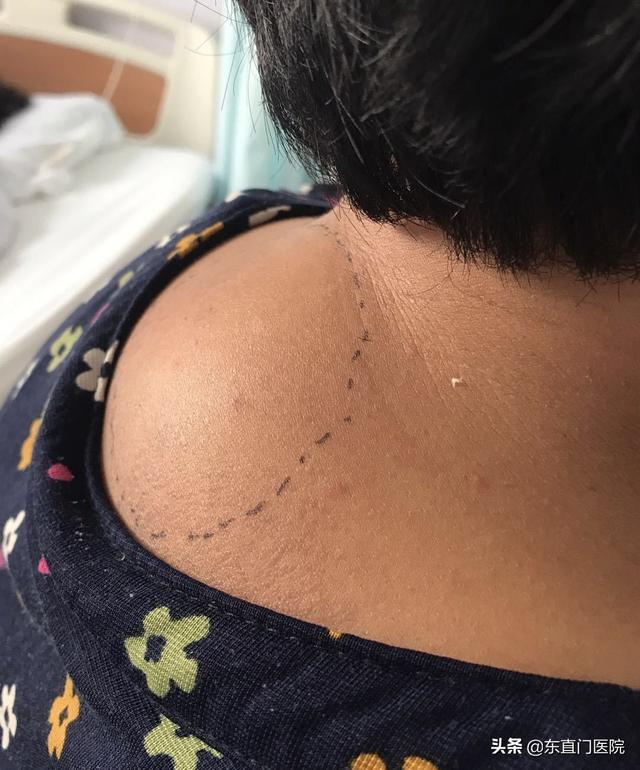 富贵包会自己消除吗 富贵包微创手术几天可以出院，富贵包会自己消除吗（东直门医院骨科外科联合研发微创可视化旋切技术治疗颈部富贵包）