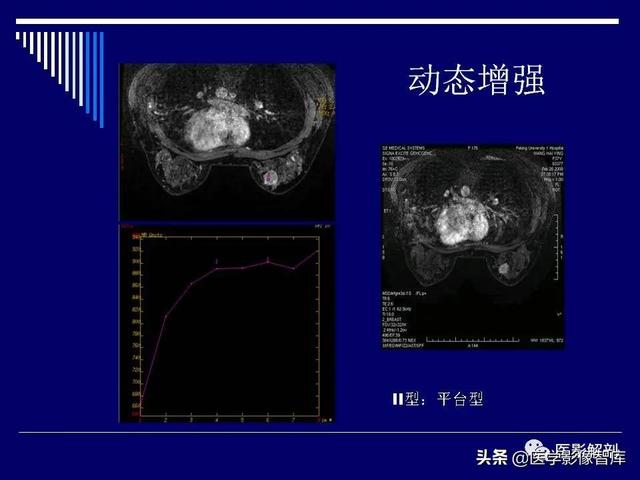 乳房解剖学基础知识，乳腺解剖及乳腺各病变影像诊断与鉴别