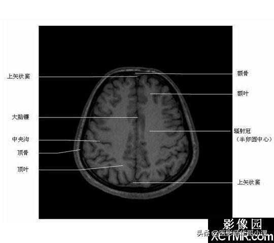 颅脑mri(头部MRI)插图(44)