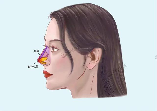 关于隆鼻的五个小常识，千万要注意避免这5个坑