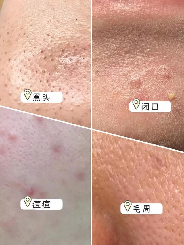 青春痘痘印怎么去除，青春痘痘印怎么去除有效（居然把我的痘痘痘印黑头都去掉了）