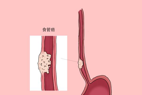 女性咽炎的症状(得了慢性咽炎能活几年了)插图(2)