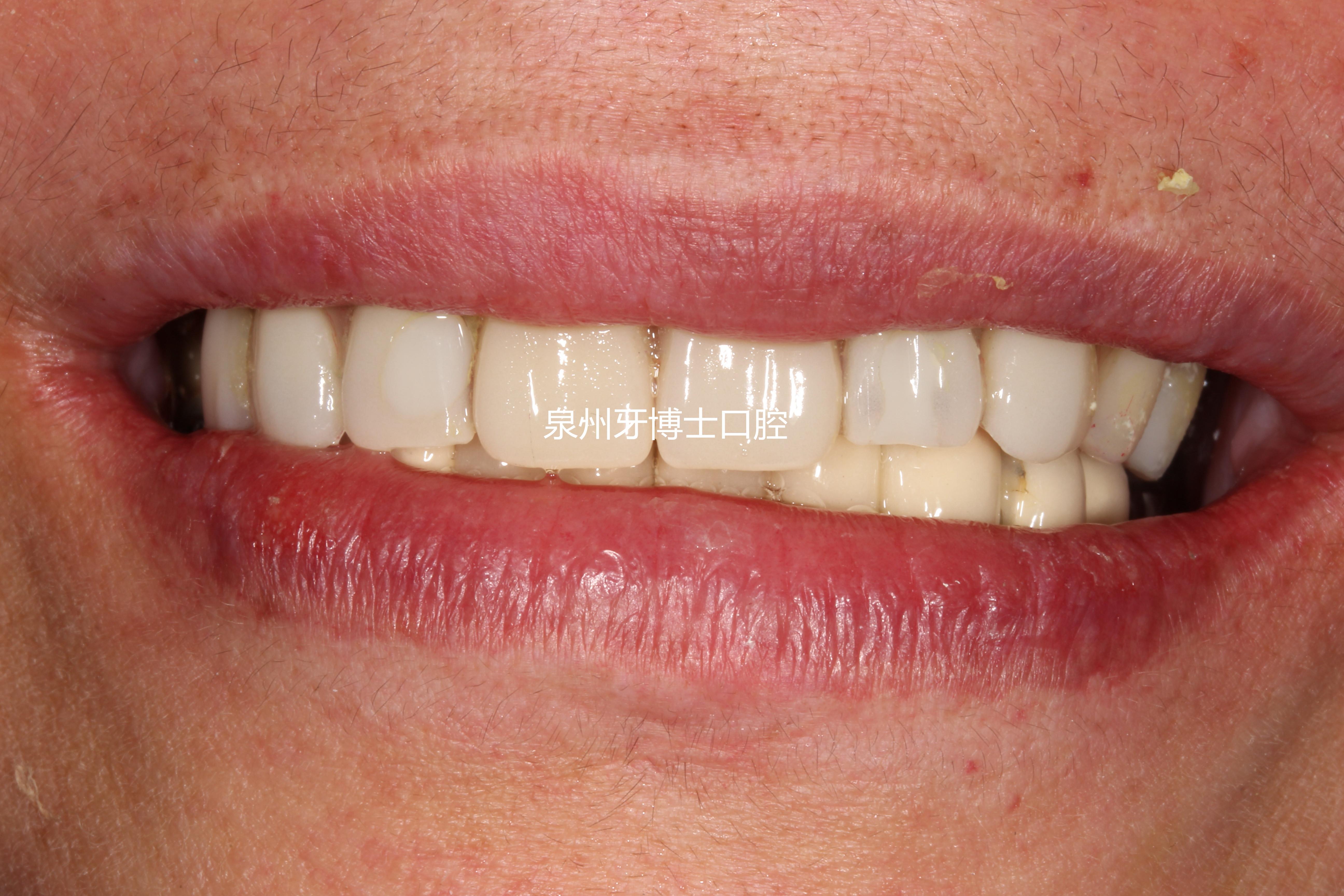 纯钛基托多少钱(一说补牙就叫你种植牙) - 价格百科