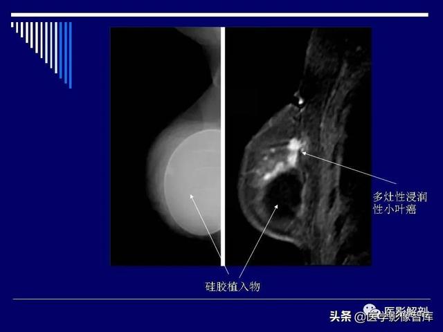 乳房解剖学基础知识，乳腺解剖及乳腺各病变影像诊断与鉴别