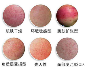 皮肤屏障受损开始恢复的表现，皮肤屏障受损的表现症状及怎么修复（皮肤屏障受损的5个表现）