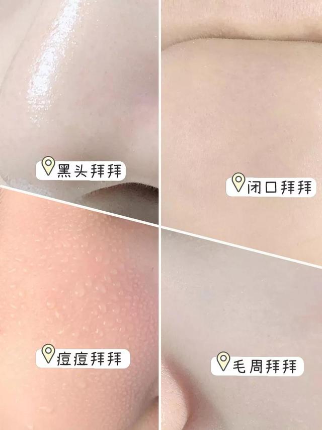 青春痘痘印怎么去除，青春痘痘印怎么去除有效（居然把我的痘痘痘印黑头都去掉了）