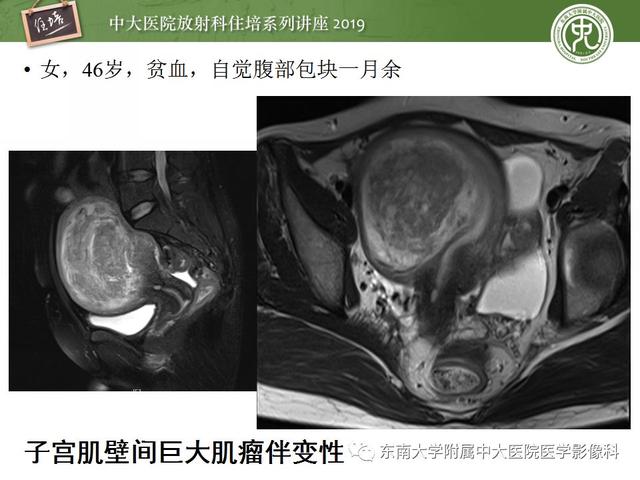 子宫颈影像解剖，子宫详细解剖及磁共振信号分析