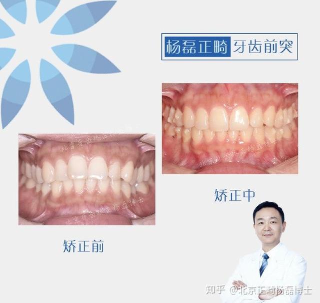 牙齿前突怎么矫正呢，上牙齿前突怎么矫正多少钱（不拔牙改善门牙前突）