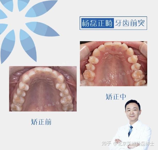 牙齿前突怎么矫正呢，上牙齿前突怎么矫正多少钱（不拔牙改善门牙前突）