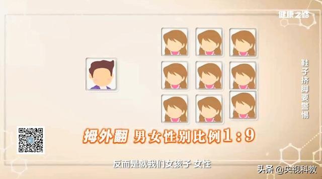 小拇指外翻怎么矫正，让你又丑又疼的拇外翻矫正方法在这里