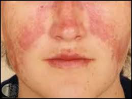 红斑狼疮是什么病图片，红斑狼疮是什么病（如此青睐年轻人的免疫疾病）