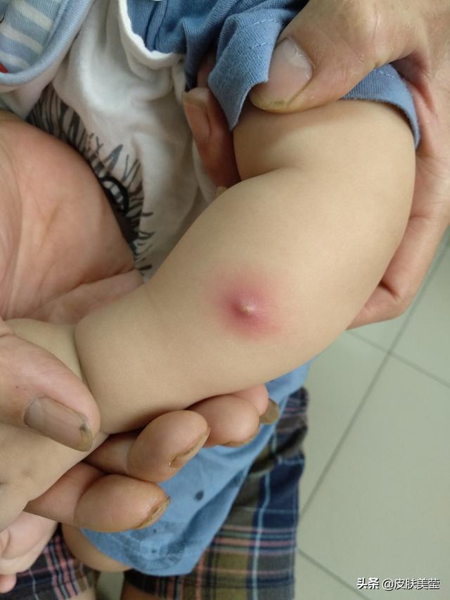 火疖子是什么引起的，火疖子会自愈吗（了解这几点火疖子可防可控）