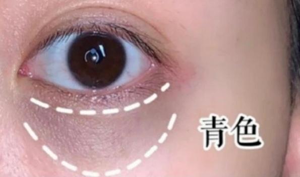 有黑眼圈怎么办，黑眼圈是什么原因（长了黑眼圈怎么办）