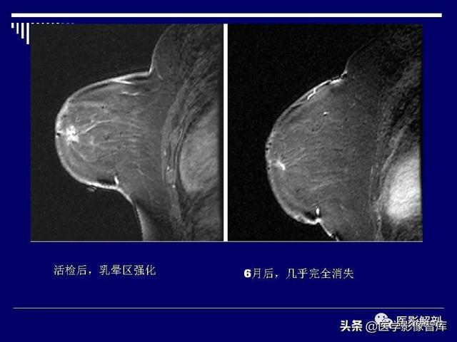 乳房解剖学基础知识，乳腺解剖及乳腺各病变影像诊断与鉴别