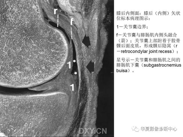 膝关节解剖结构图，膝盖解剖图示意图（膝关节MRI之正常解剖综述）