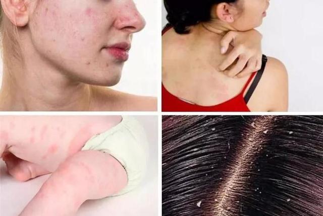 小螨虫的危害有多大，小小的螨虫对人体的危害有多大