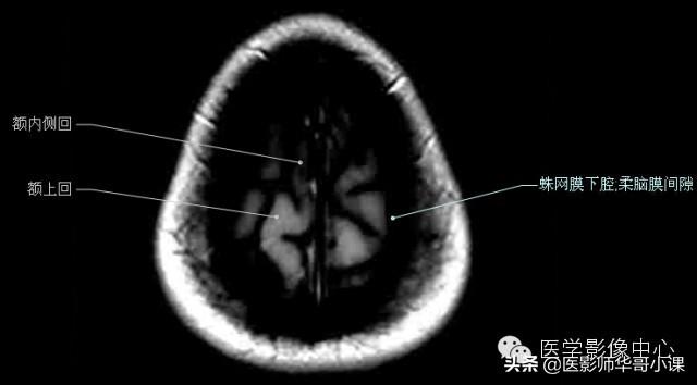 颅脑mri(头部MRI)插图(21)