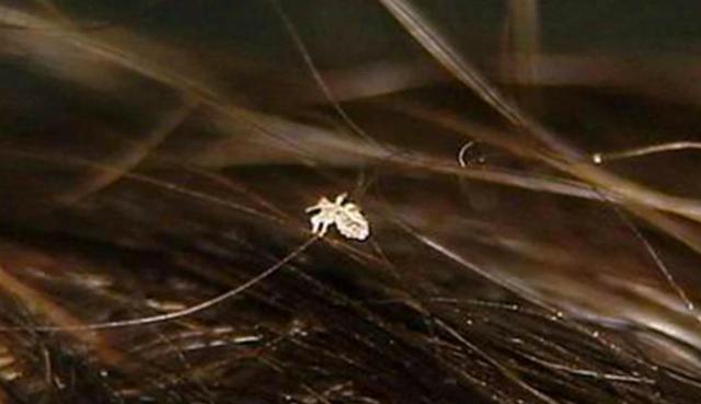 虱子卵长什么样，虱子卵（30年前农村人人都长的虱子）