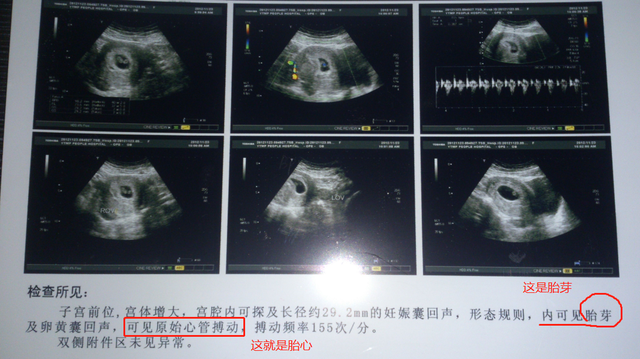 怀孕初期检查什么，怀孕初期做哪些检查项目（孕妈要心里有数）