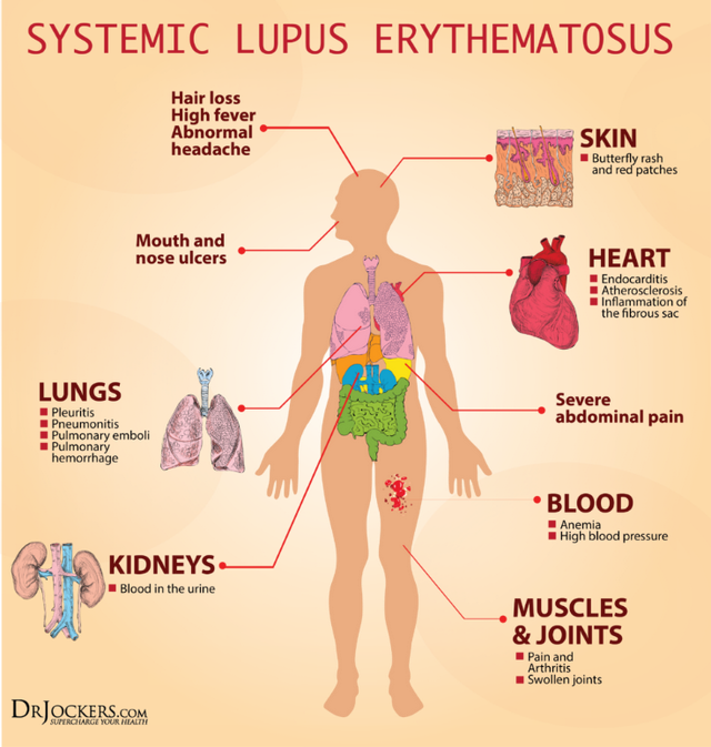 红斑狼疮是什么病图片，红斑狼疮是什么病（如此青睐年轻人的免疫疾病）