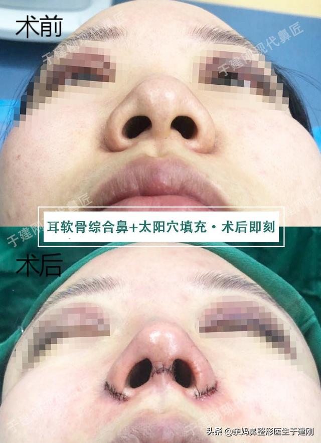 一张图看懂鼻基底凹陷对比图，塌鼻秒变立体质感鼻