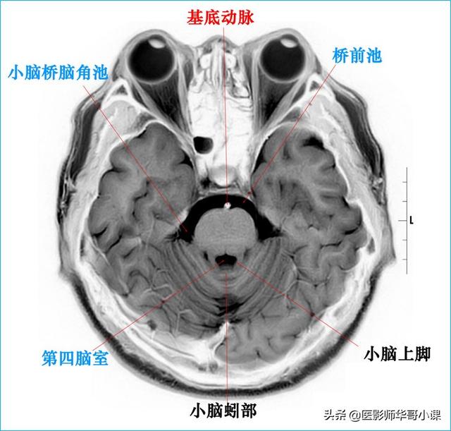 头颅ct解剖图，头部骨骼结构图（颅脑磁共振MRI解剖结构以及高清图谱）