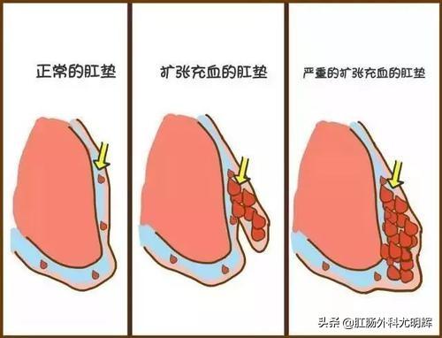 痔疮的分类及分级，我们教你分辨痔疮的严重程度