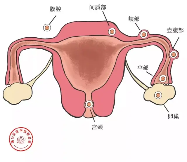 慢性输卵管炎什么意思，什么是慢性输卵管炎（切除输卵管，以后还能怀孕吗）