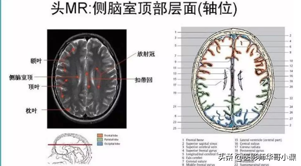 颅脑mri(头部MRI)插图(68)