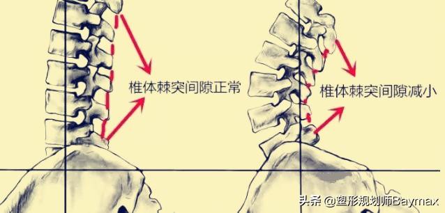 骨盆前倾的危害，骨盆前倾的危害和表现（产后腰痛千万不要做这个动作）