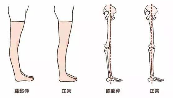 改变小腿外翻最有效的方法，怎么有效改善小腿外翻（小腿外翻如何纠正）