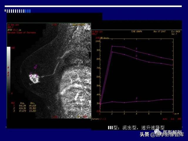 乳房解剖学基础知识，乳腺解剖及乳腺各病变影像诊断与鉴别