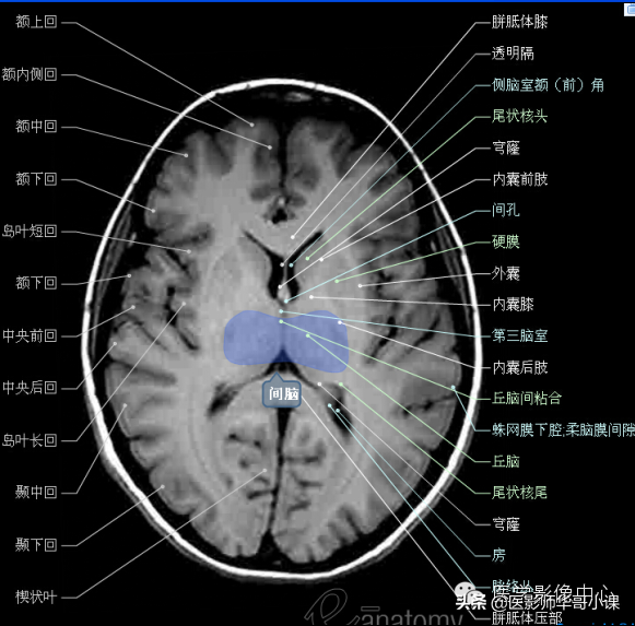 颅脑mri(头部MRI)插图(31)