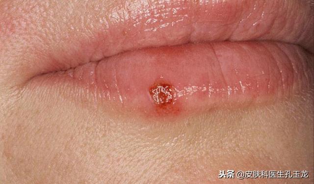 嘴唇上长疱疹图片，嘴唇长疱疹怎么治疗（嘴唇上火的真相——单纯疱疹）