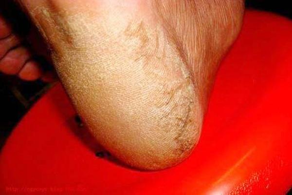 脚后跟干裂起硬皮是什么原因，女性脚后跟干裂起硬皮是什么原因怎么治（可能和4个原因有关）