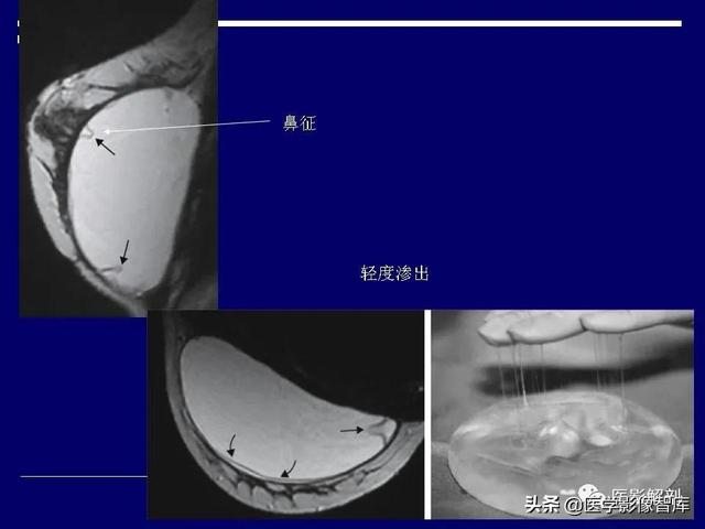 乳房解剖学基础知识，乳腺解剖及乳腺各病变影像诊断与鉴别