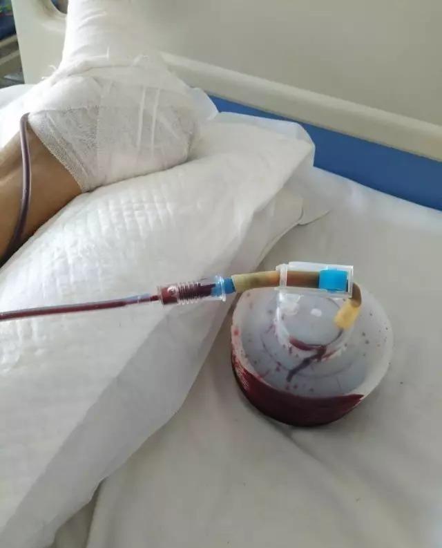 胆囊切除后引流管作用(三分治疗) - 行就行