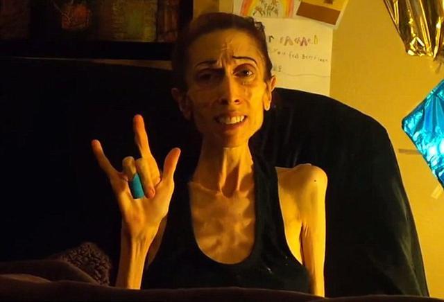 少女减肥上瘾,靠饮水充饥,导致月经停访,厌食症有多"骇人"?