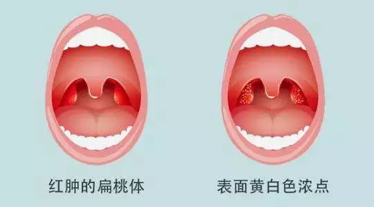 扁桃体发炎最怕三种水果柑橘(扁桃体发炎吃什么水果最有效的方法)